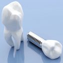 Dental crowns – more protective than standard fillings