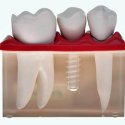 Dentures vs. implants – why would I choose them?